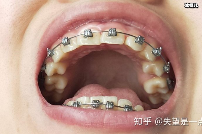 龅牙矫正能够改进突嘴吗？