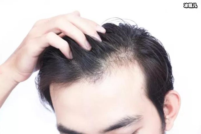 脱发掉发严重发际线后移头发稀少你到底怎么了！