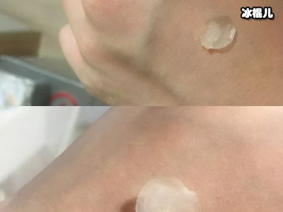 痘痘贴真的有作用吗？吸出脓液消红肿助恢复就用可致美隐形痘痘贴！